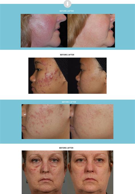 Laser Genesis — Lakes Dermatology