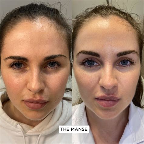 Botox Eyes Before And After
