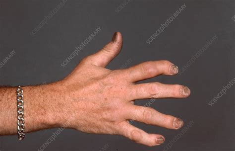 Psoriatic Arthritis, Hand - Stock Image - C036/5641 - Science Photo Library