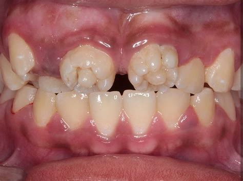6 year old molars symptoms - Captions Feature