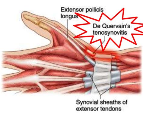 Dequervain’s Tenosynovitis – South Florida Hand Surgery