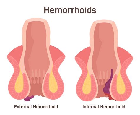 internal hemorrhoids symptoms