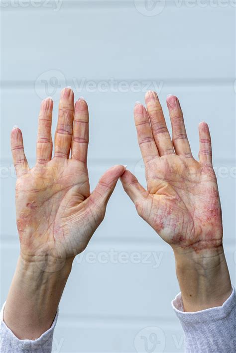 Hands displaying signs of eczema and psoriasis with visible redness and
