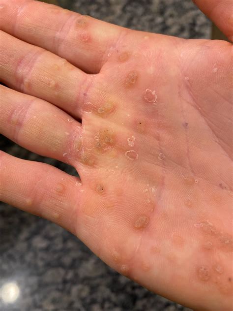 Hundreds of Seed Warts! HELP!! : r/Warts