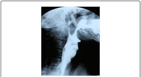 swallowing  device  position easy  functional swallowing