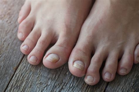 how to fix a cracked toe nail