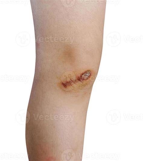 Scar and scab eschar on the knee 11870527 Stock Photo at Vecteezy