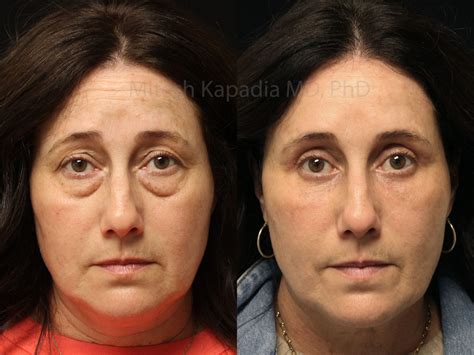 Before and 4 months after upper and lower blepharoplasty surgery with
