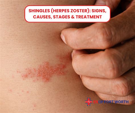 Early Rash Shingles Symptoms