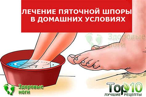Топ-10 методов лечения пяточной шпоры в домашних условиях. Проверенные ...