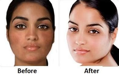 Skin Bleaching Cream Before And After Pictures - PictureMeta