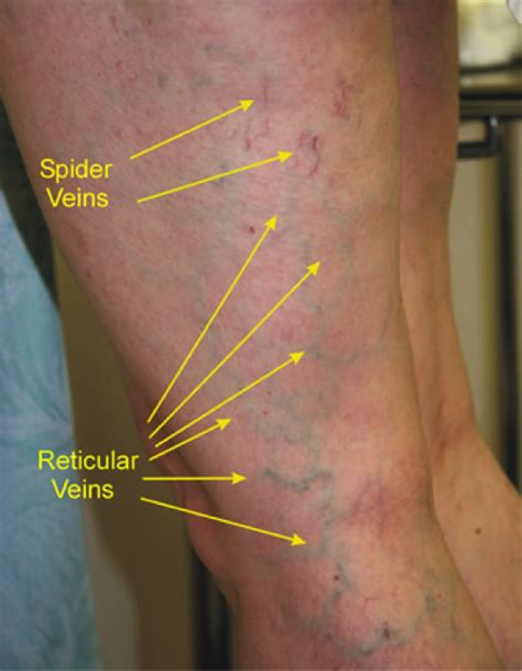 aching vein  thigh  nicholas heaton blog