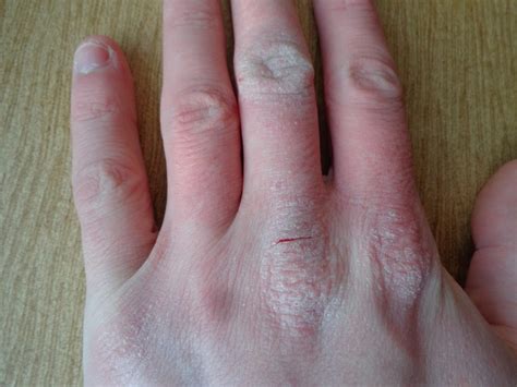 Atopic dermatitis hand - BioSol