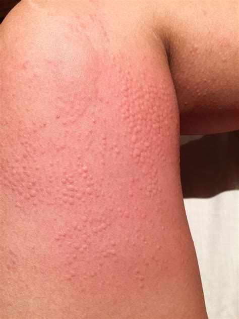 Cold Urticaria Urticaria Treatment In Chennai