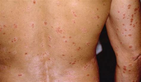 What is Guttate Psoriasis? Causes and Best Treatment Options - Easy ...