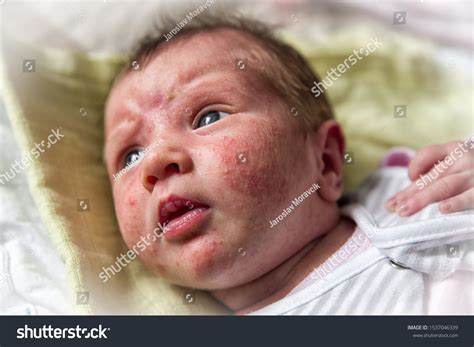Acne neonatorum Images, Stock Photos & Vectors | Shutterstock