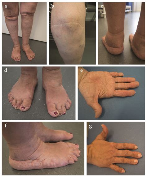 Figure From Ehlers-Danlos Syndrome, Hypermobility Type: An, 54% OFF