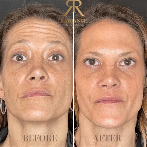 forehead treatment    images bothell wa