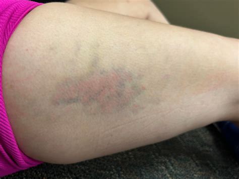 Spontaneous bruise on thigh- no trauma?? : r/DiagnoseMe