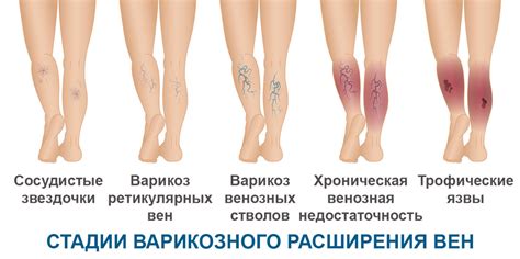 Варикозное расширение вен нижних конечностей: симптомы, диагностика и ...
