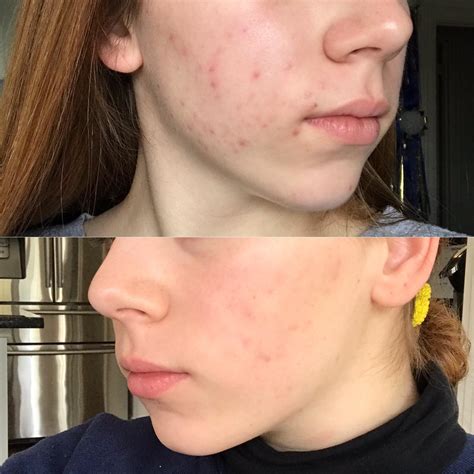 Mild Cystic Acne Acne Vulgaris