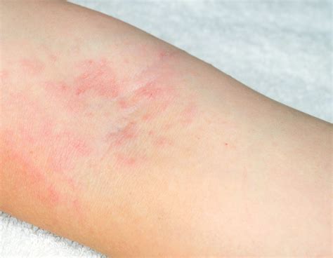 Pictures Of Skin Rashes Different Type Of Skin Rashes Healthy | My XXX