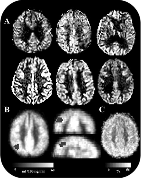 top representative cbf axial images      subjects