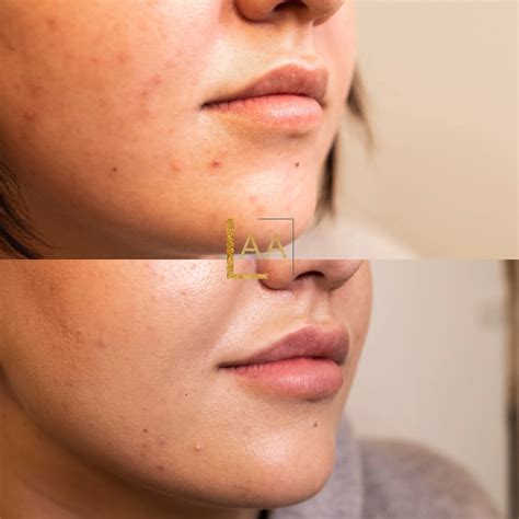 Before/After — LOOK Aesthetic Atelier