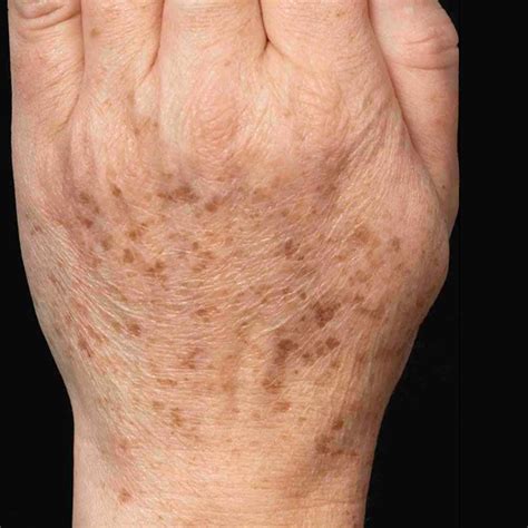 Hyperpigmentation Treatment in Abu Dhabi - Best Dermatologist