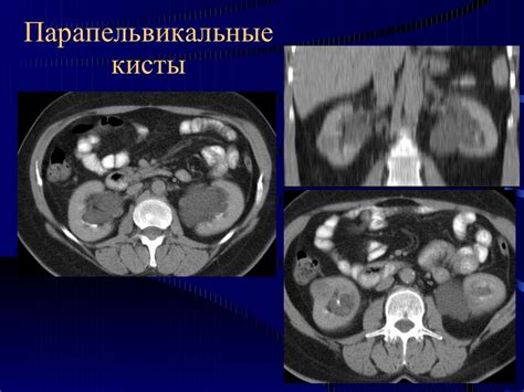 Почки, КТ-диагностика