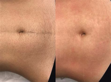 Do I shave before laser hair removal?