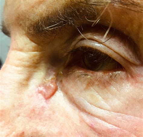 Eyelid Cancer Pictures | Ahmad Aziz