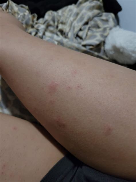 Komischer ausschlag am bein? (Beauty, Haut, Pflege)