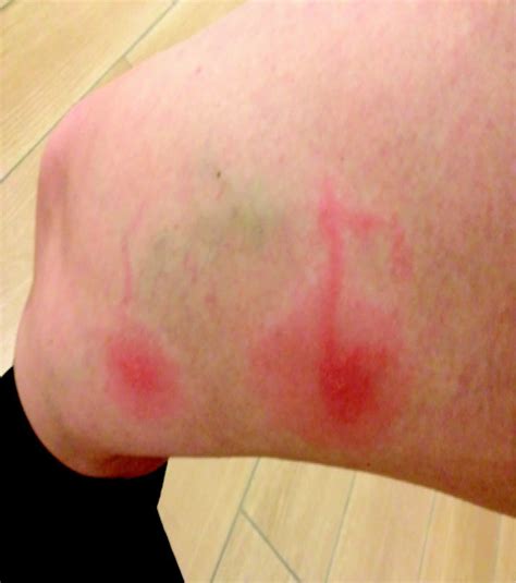 Leg Swollen From Bite at Zachary Fry blog