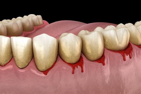 Como Estancar Sangue Do Dente