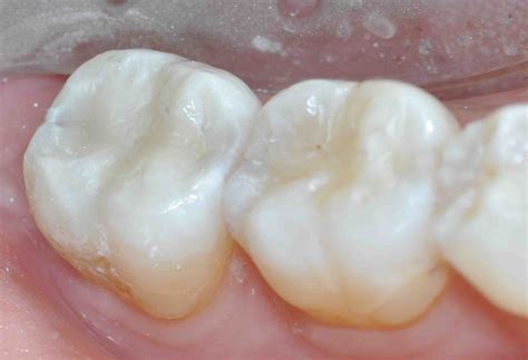 Posterior Composite Prep Bevels: Yes or No? - Lee Ann Brady, DMD's