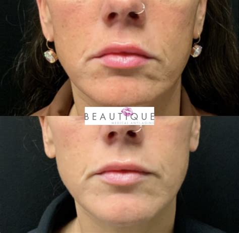 radiesse knoxville beautique medical anti aging