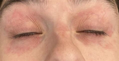 Eye eczema pain : r/eczema