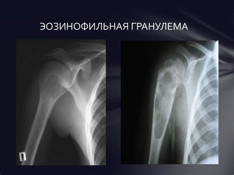 Доброкачественные опухоли костей - презентация онлайн