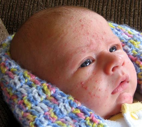 Who Gets Acne?