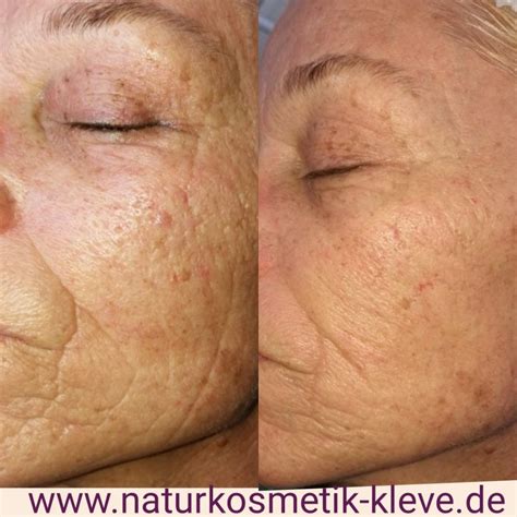 Mezotix ® in Bedburg-Hau bei Naturkosmetikerin Susanne Kaußen