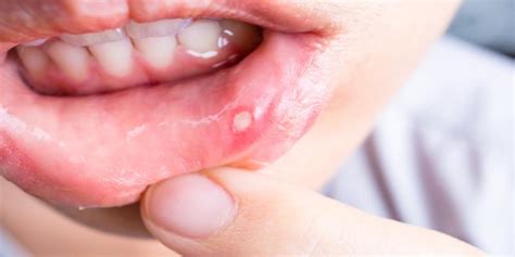 Mouth Ulcer Treatment Chennai | Oral & Tongue Ulcer Treatment India