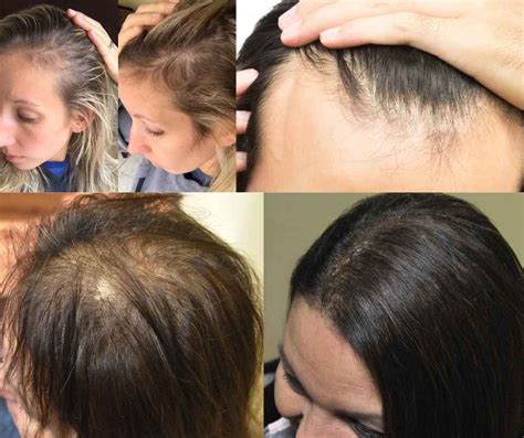 how to hide hair loss