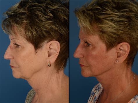 The UpLift™ Lower Face and Neck Lift Photos | Naples, FL | Patient 14461