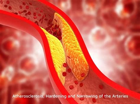 critical limb ischemia awareness  american heart month