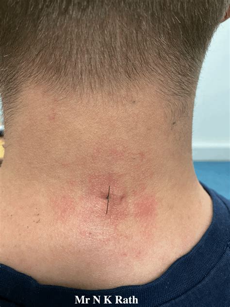 Endoscopic cervical foraminotomy - Cheshire Spine