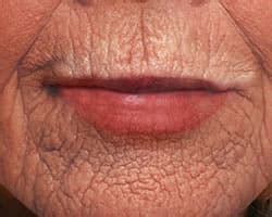 Diagnosing Skin Glycation - Virtual Beauty Corporation