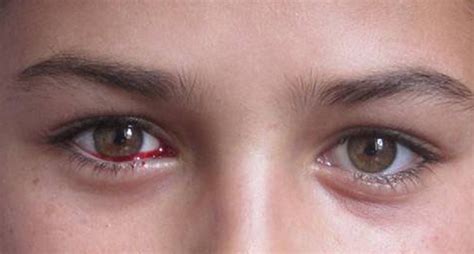 Bloody Tears May Signal Malignancy
