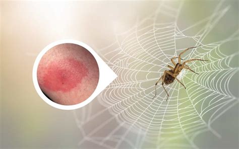 Wolf Spider Bite: Stages and Symptoms with Pictures