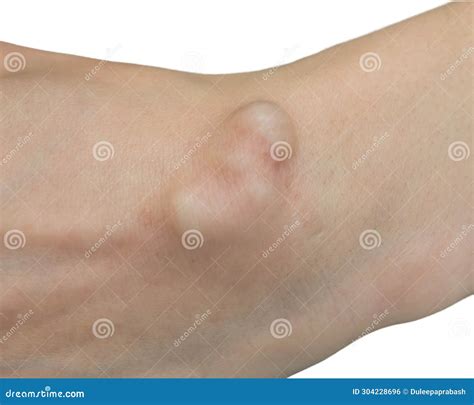 Wrist Ganglion Cyst Disease , Ganglion Cyst , a Fluid-filled Lump Under ...